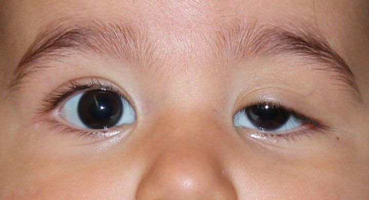 bấm mí cho trẻ nhỏ