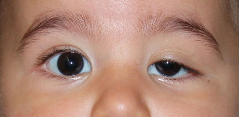 bấm mí cho trẻ nhỏ