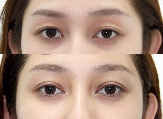 bấm mí mắt làm thay đổi khuôn mặt