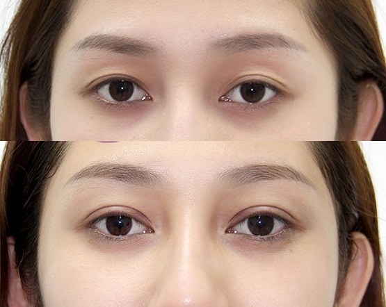 bấm mí mắt làm thay đổi khuôn mặt