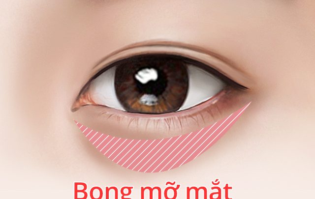 lấy bọng mỡ mí mắt