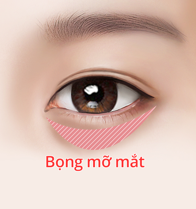 lấy bọng mỡ mí mắt