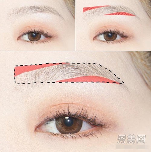 treo-chân-mày-nội-soi_1