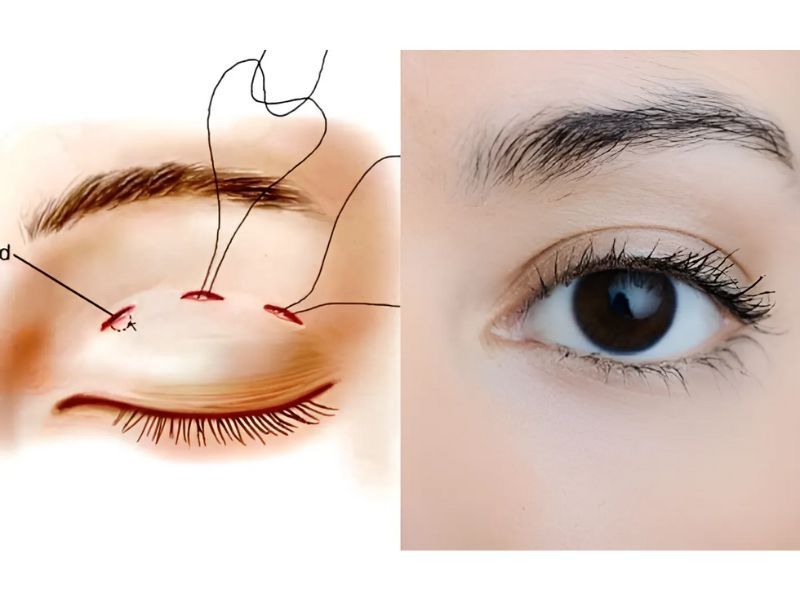 bấm mí mắt giữ được bao lâu