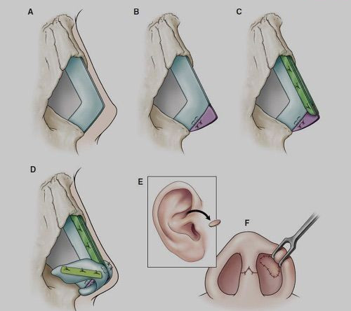 nang-mui-ban-cau-truc-1
