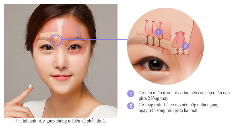 treo-chan-may-noi-soi2