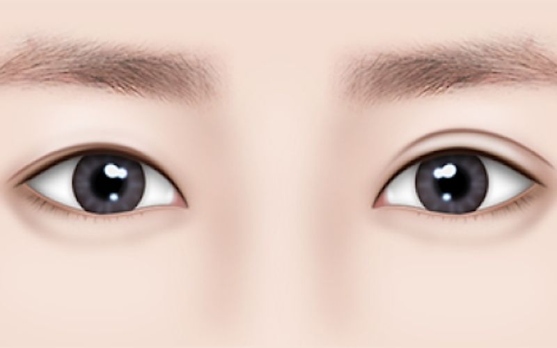 bấm mí không đều