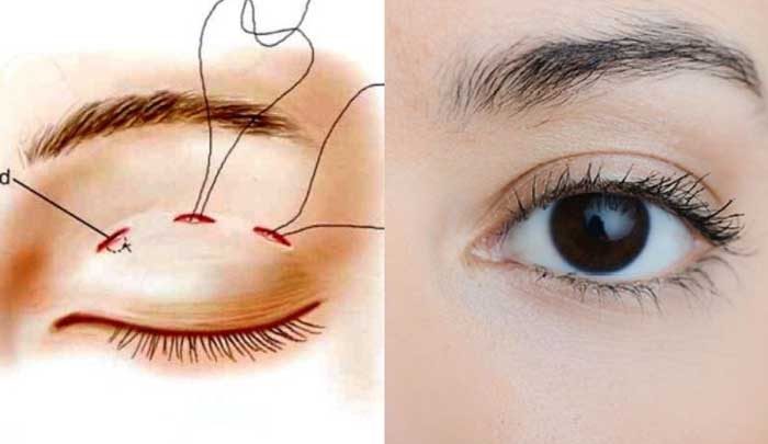 bấm mí mắt tại quận 10 tphcm