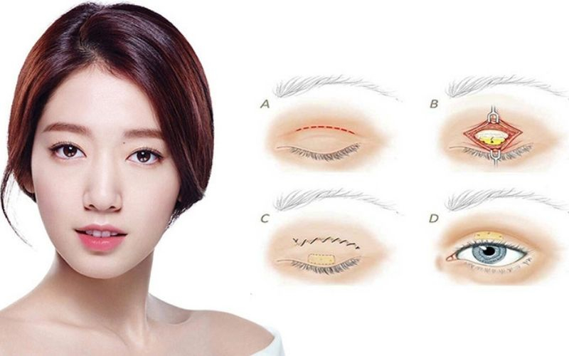 bấm mí mắt bao nhiêu tiền