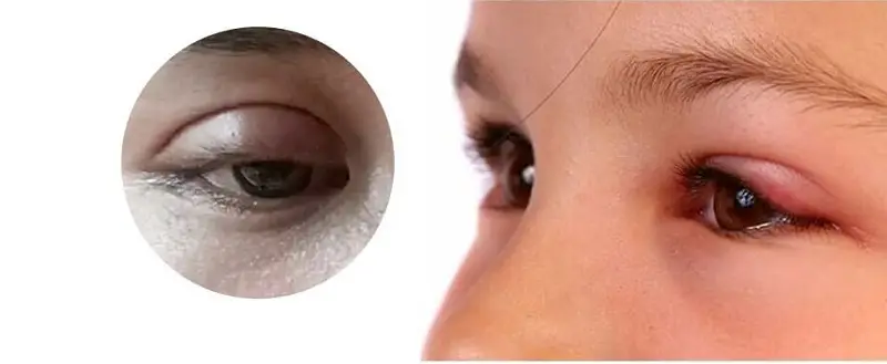 bấm mí có sưng nhiều không