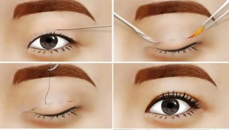 bấm mí mắt có đau khong