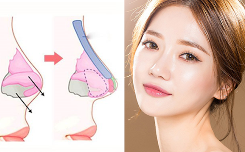 nâng mũi sụn nhân tạo