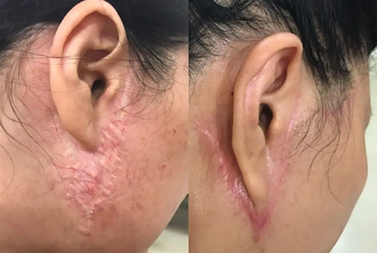 căng da mặt bị sẹo
