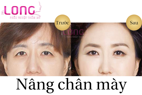 nang-chan-may-co-vinh-vien-khong-1