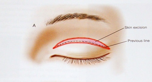 Thực hiện quy trình phẫu thuật cắt mí mắt để mang lại  vẻ đẹp cho cửa sổ tâm hồn
