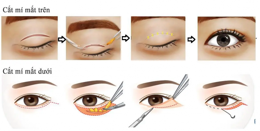 Quy trình phẫu thuật cắt mí mắt được tiến hành qua 5 bước nhanh gọn