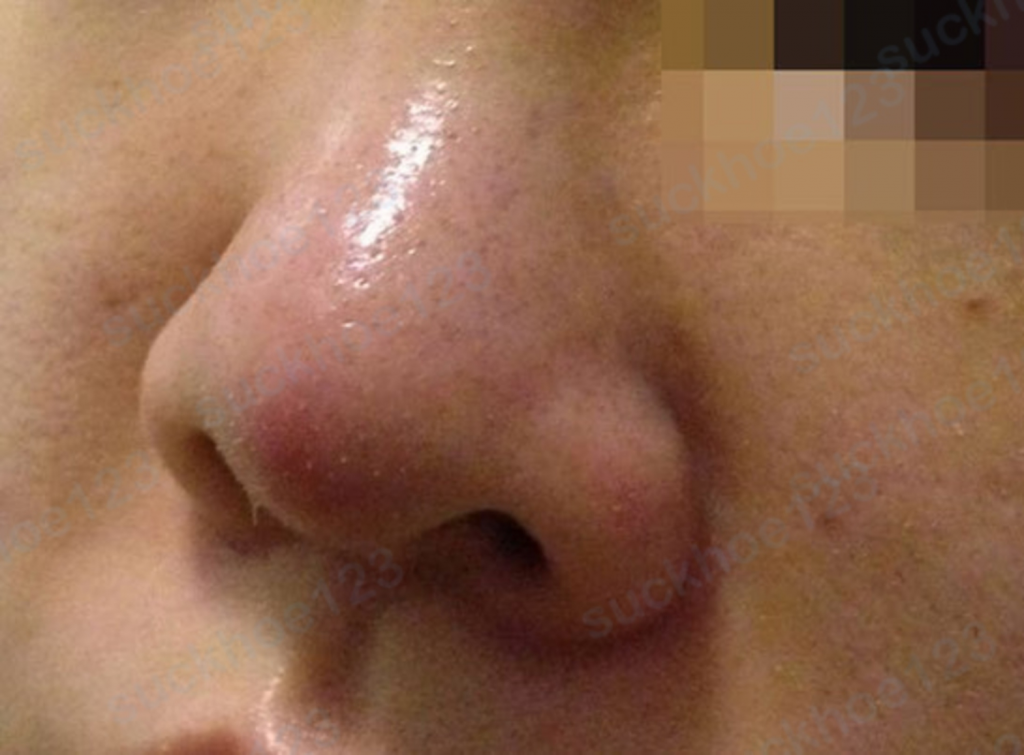 Phần lớn người dùng sẽ bị ửng đỏ đầu mũi trong vòng 7 - 10 ngày hậu phẫu thuật 