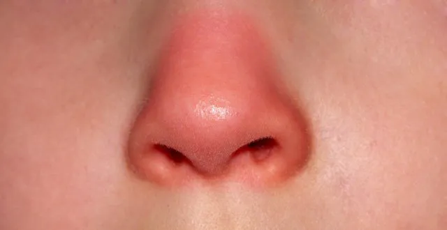 Đầu mũi sẽ bị sưng đỏ sau 3 - 6 tháng phẫu thuật nâng mũi