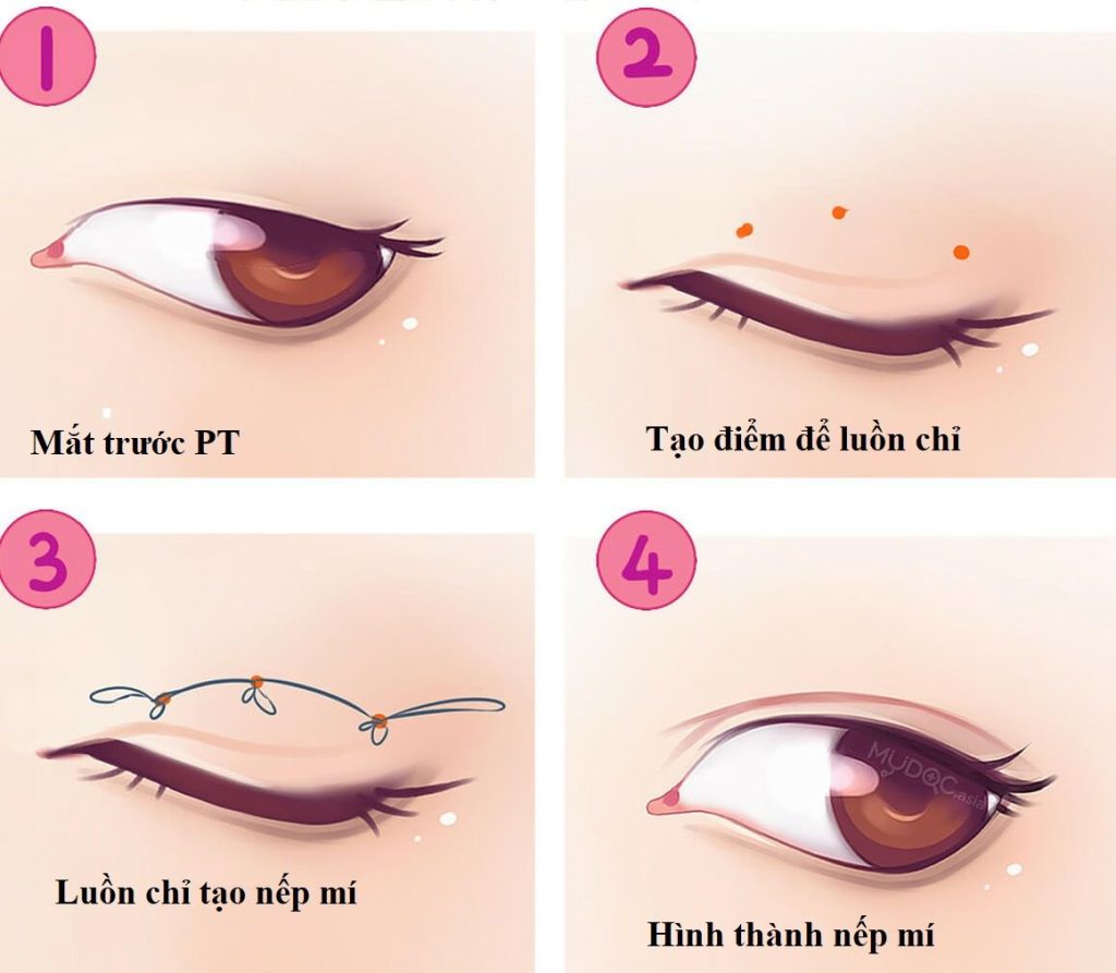 Quy trình bấm mắt 2 mí