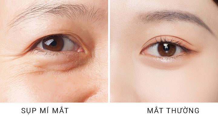 bấm mí mắt bị sụp