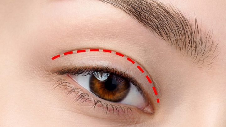 bấm mắt 2 mí có cần kiêng ăn không