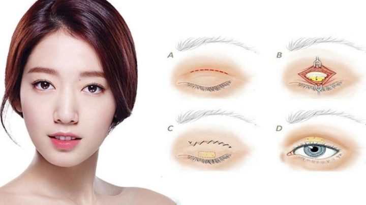 bấm mí mắt bao nhiêu tiền