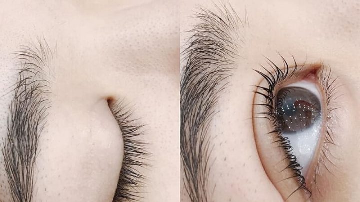 cắt mí to hay cắt mí nhỏ