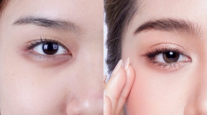 bác sĩ tạo mí mắt đẹp