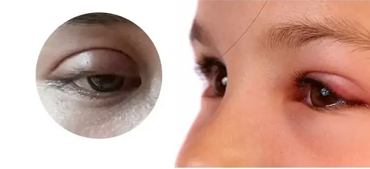 bấm mí có sưng nhiều không