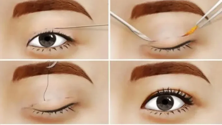 bấm mí mắt có đau khong