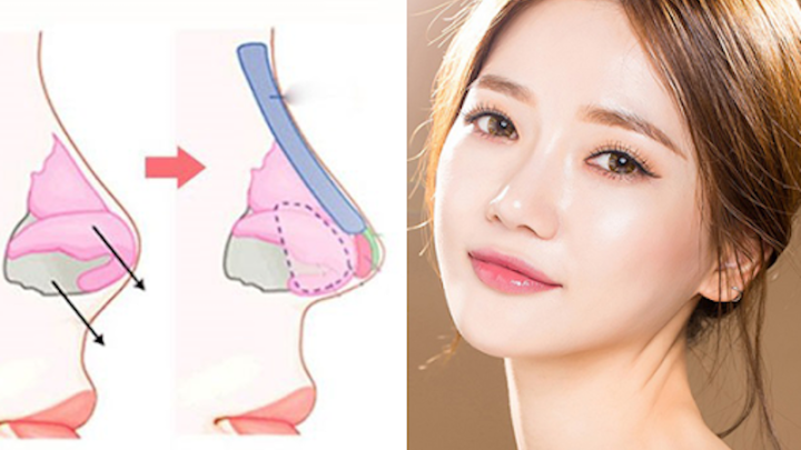nâng mũi sụn nhân tạo