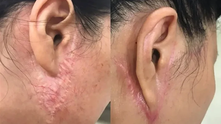 căng da mặt bị sẹo